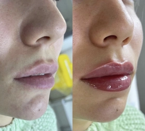 Увеличение губ, доктор Гюльмира Магамедова