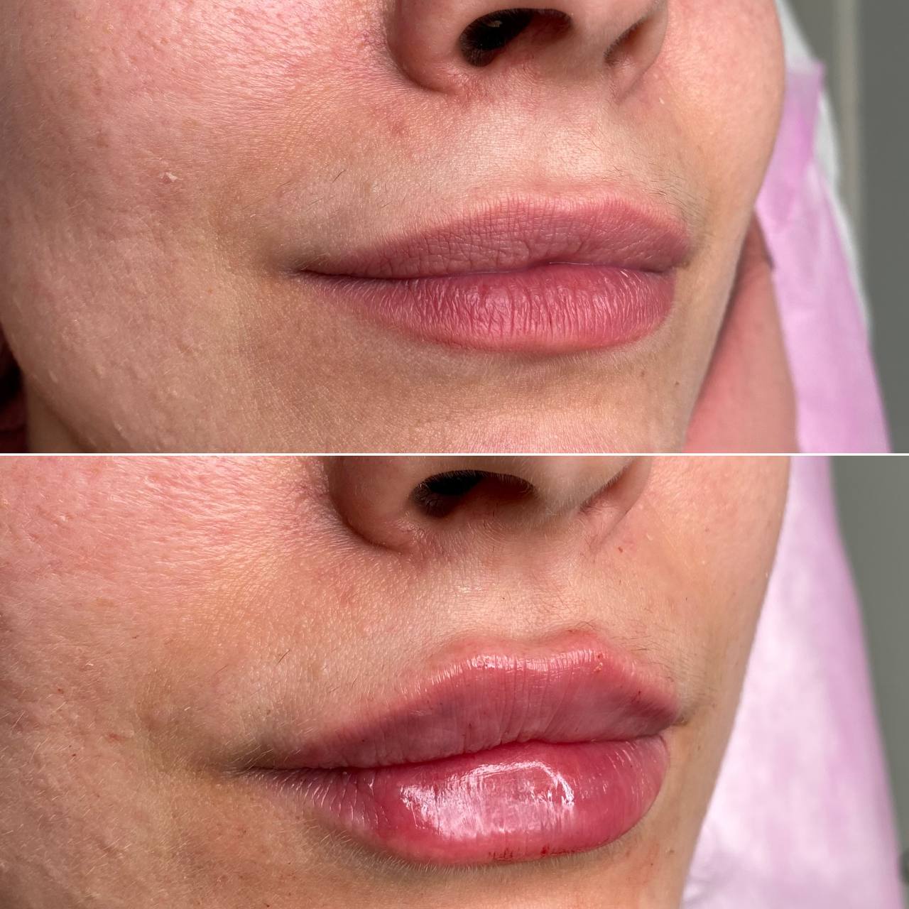 Увеличение губ, доктор Анастасия Асаенок