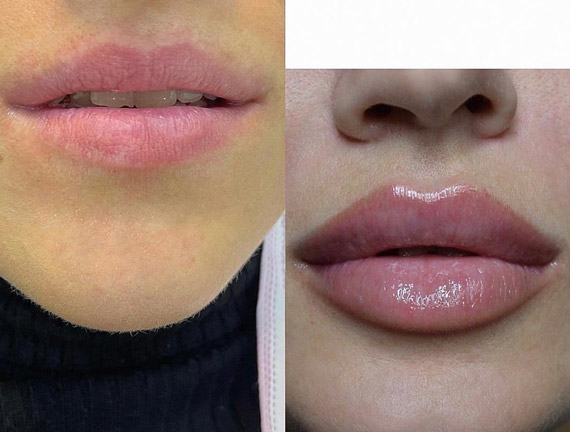 Увеличение губ, доктор Гюльмира Магамедова