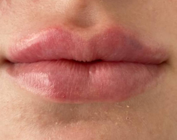 Коррекция губ препаратом Теосиаль RHA2, доктор Бителева Н.Е.