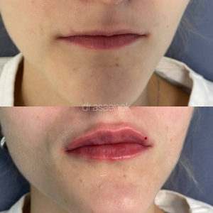Увеличение губ, доктор Анастасия Асаенок