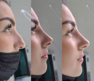 Коррекция формы носа, доктор Гюльмира Магамедова